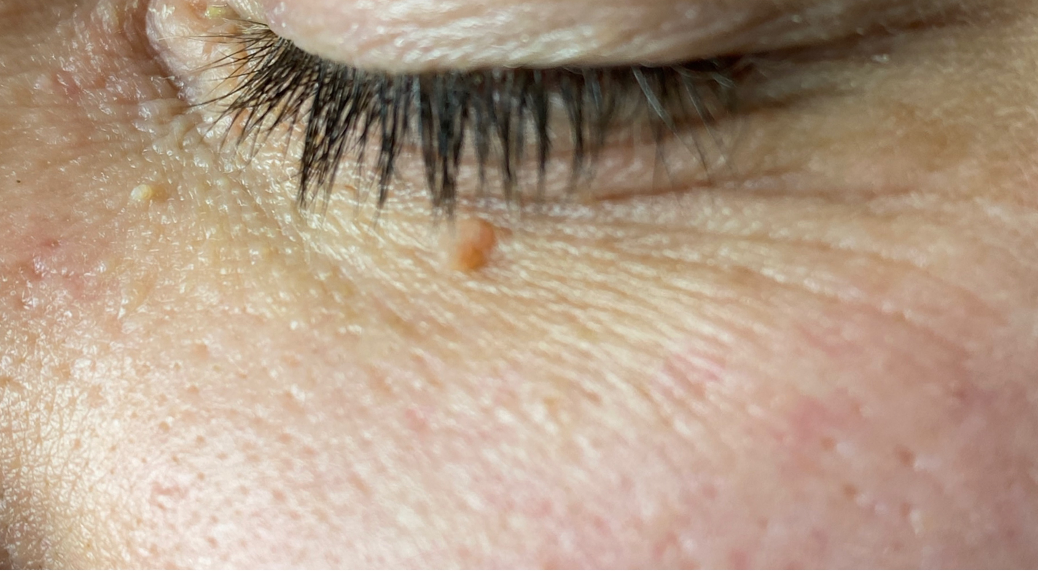 Close-up of a person's eye with visible skin texture and pores.