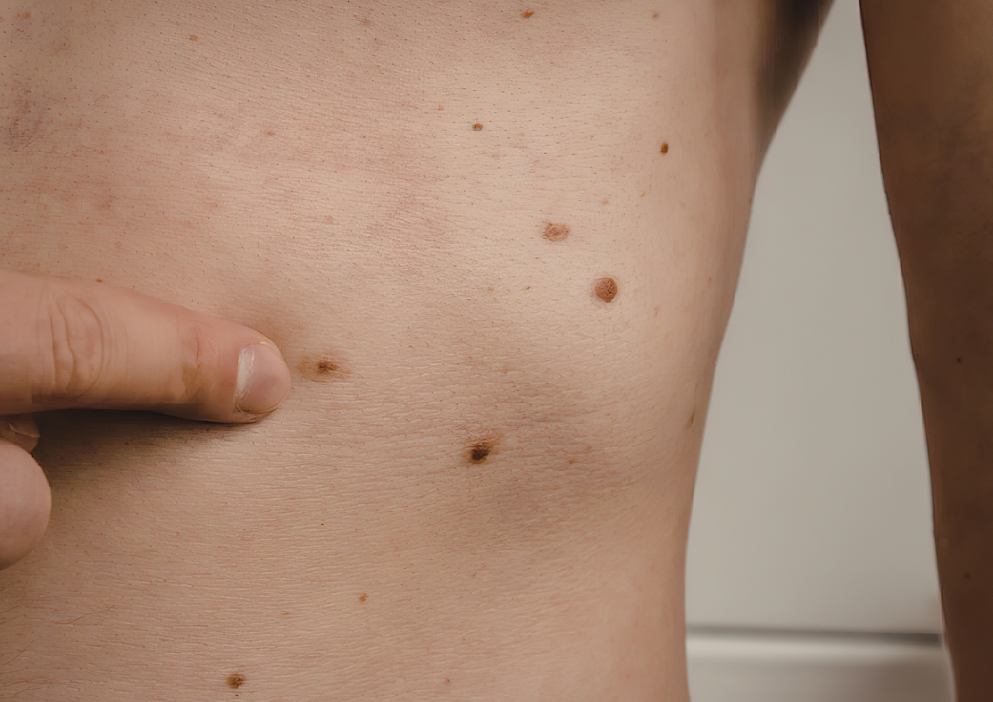 Close-up of a person's torso with a hand pointing to a mole.