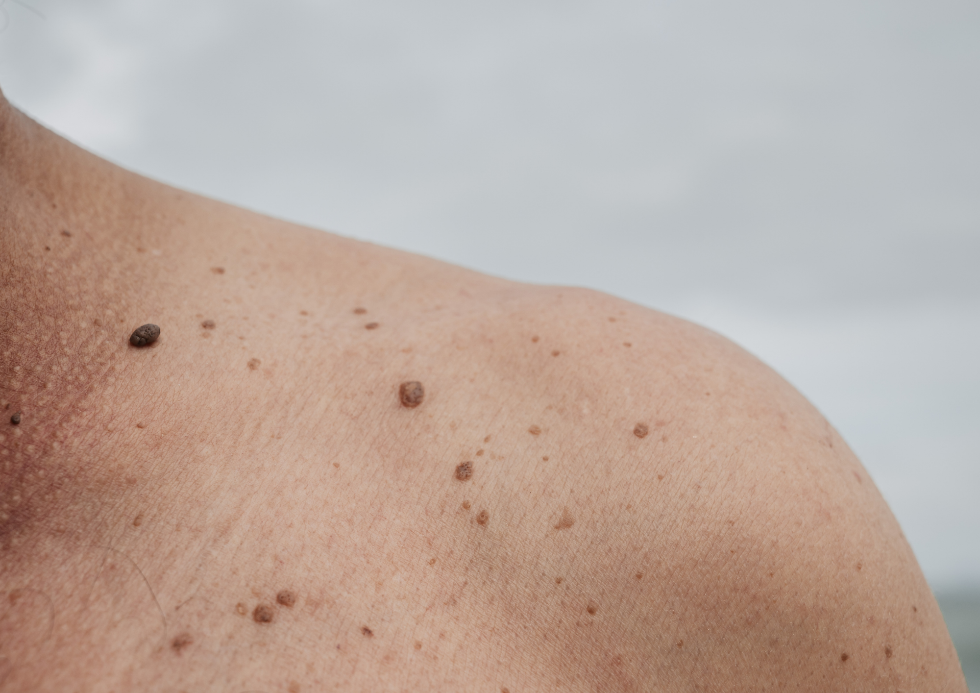 Close-up of a person's shoulder with visible moles and skin texture against a neutral background