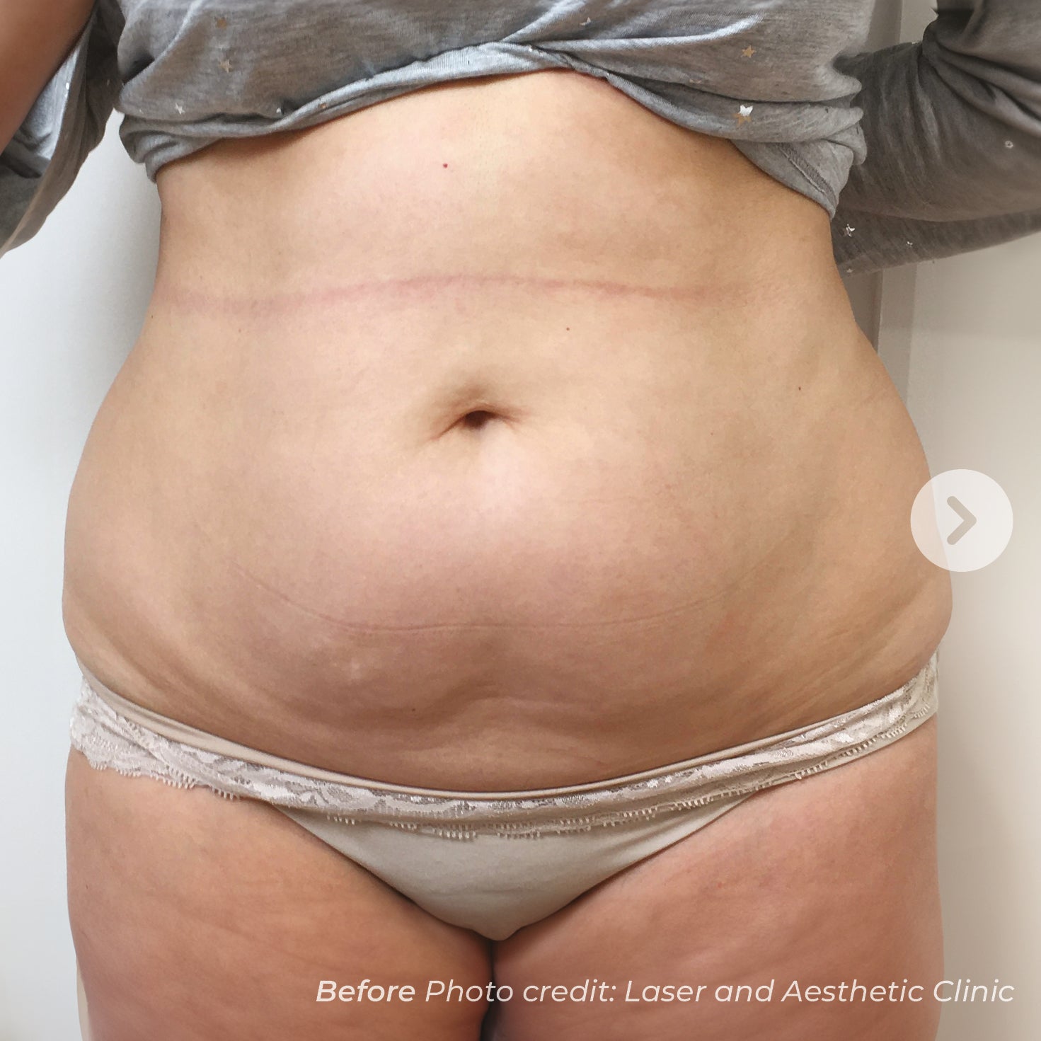 Before photo of a person's abdomen with visible stretch marks, wearing a gray top and white underwear.