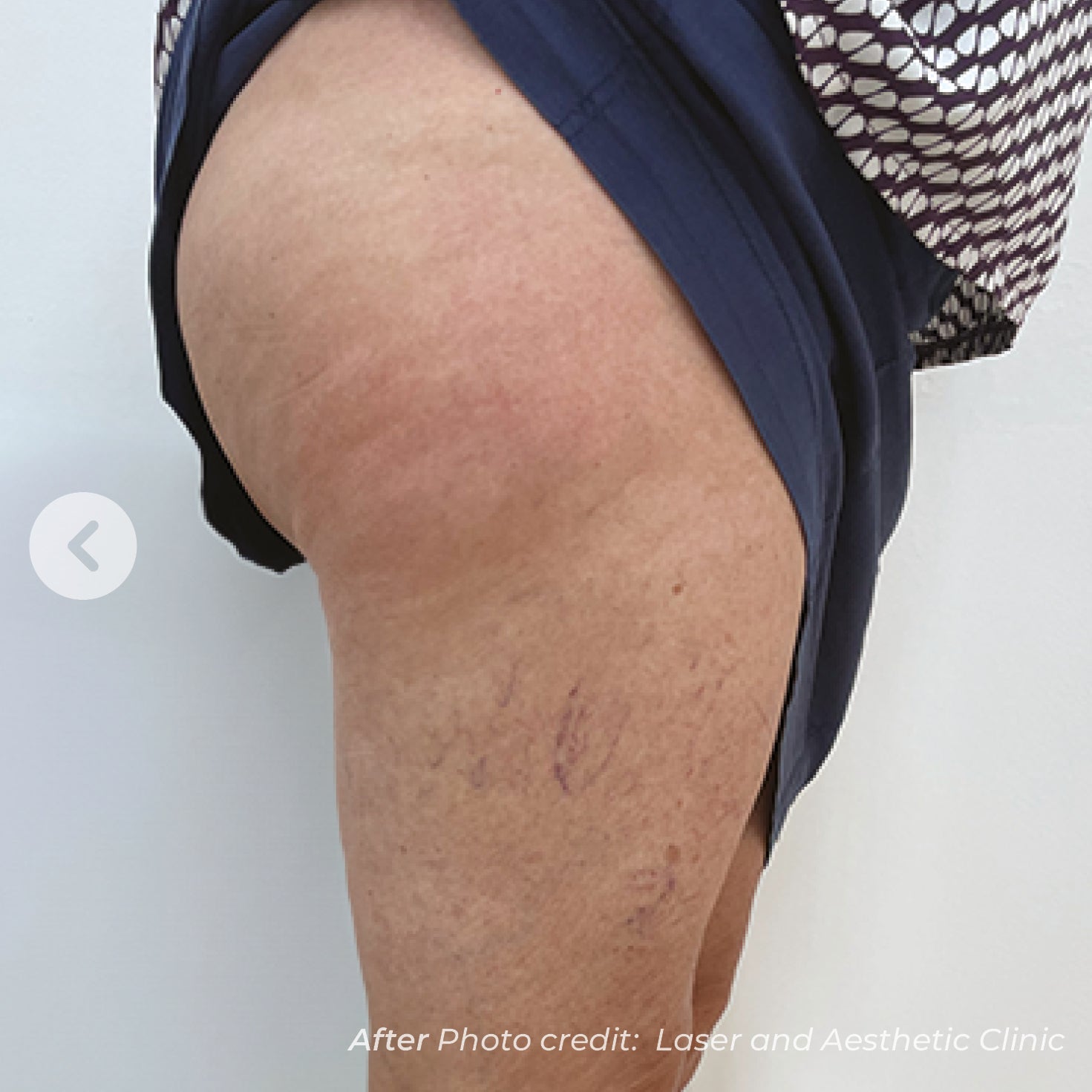 Leg with visible vein treatment on a plain background