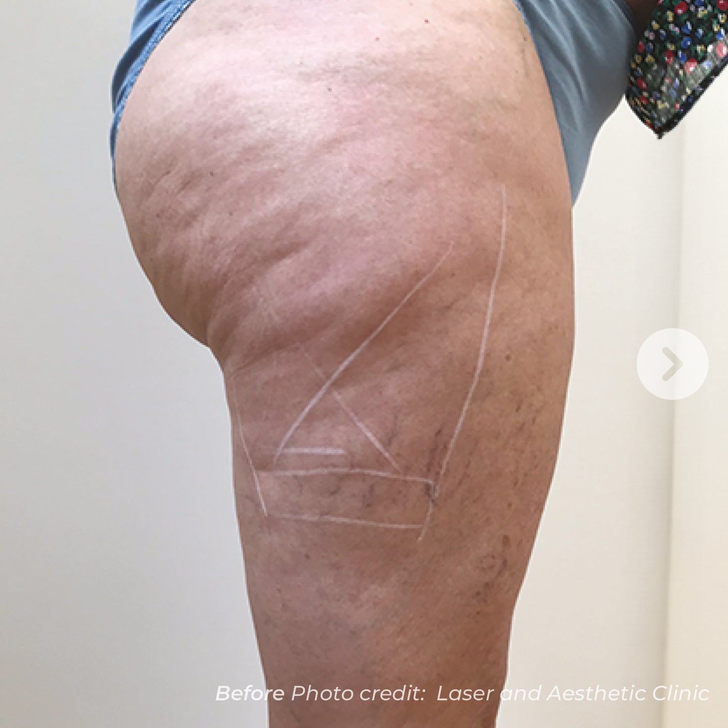 Before photo of a leg with laser treatment markings, credit to Laser and Aesthetic Clinic.