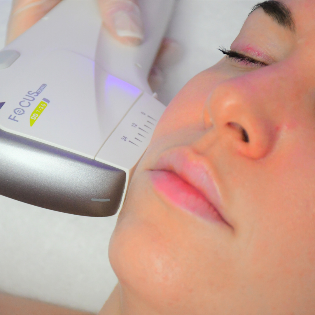Person receiving a laser treatment on their face with a device labeled 'FOCUS'.