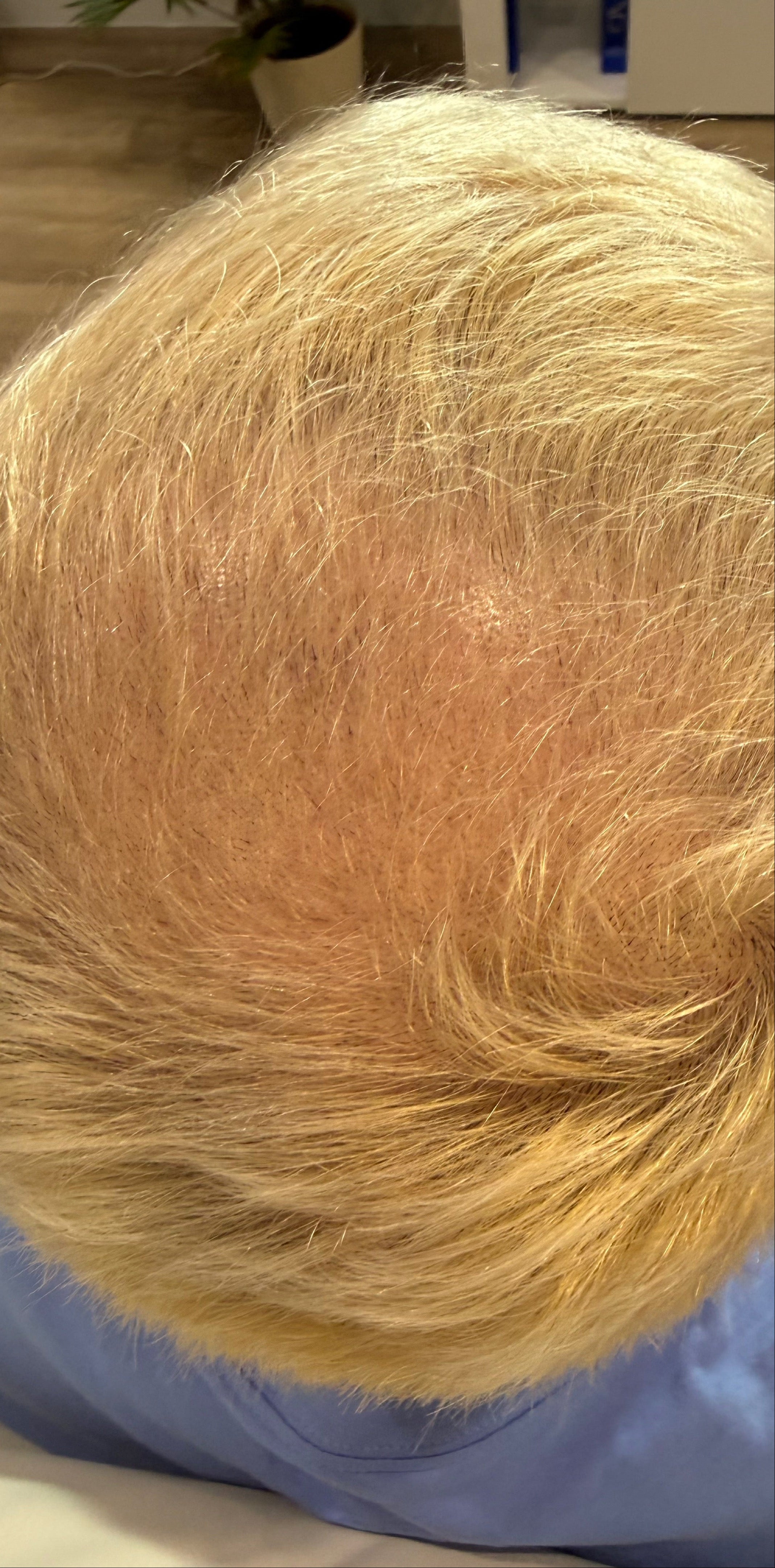 The image shows fuller, denser golden-blonde hair following hair restoration treatment.