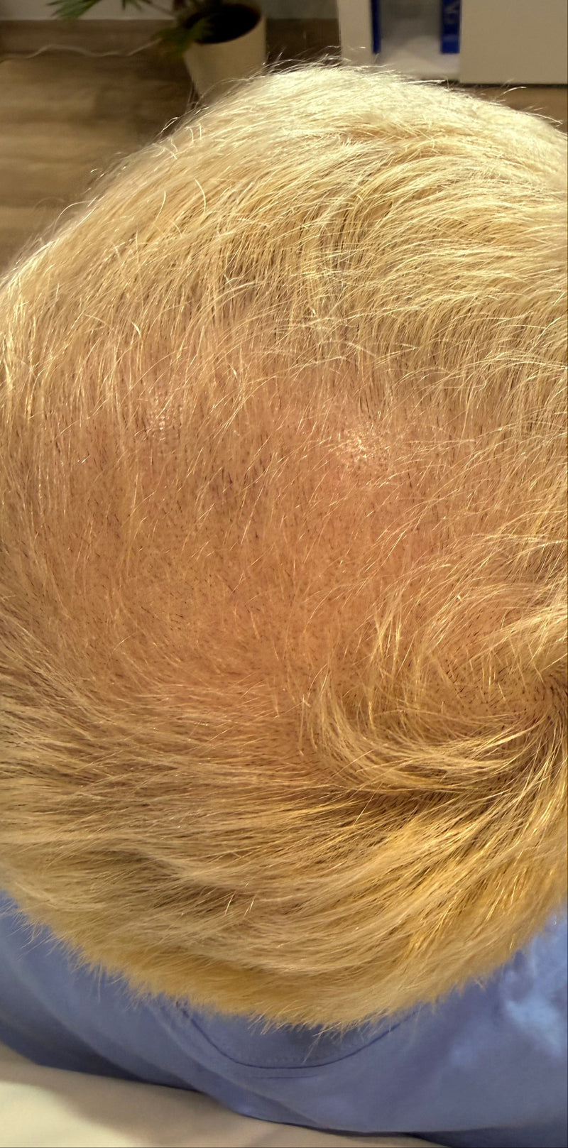 The image shows fuller, denser golden-blonde hair following hair restoration treatment.