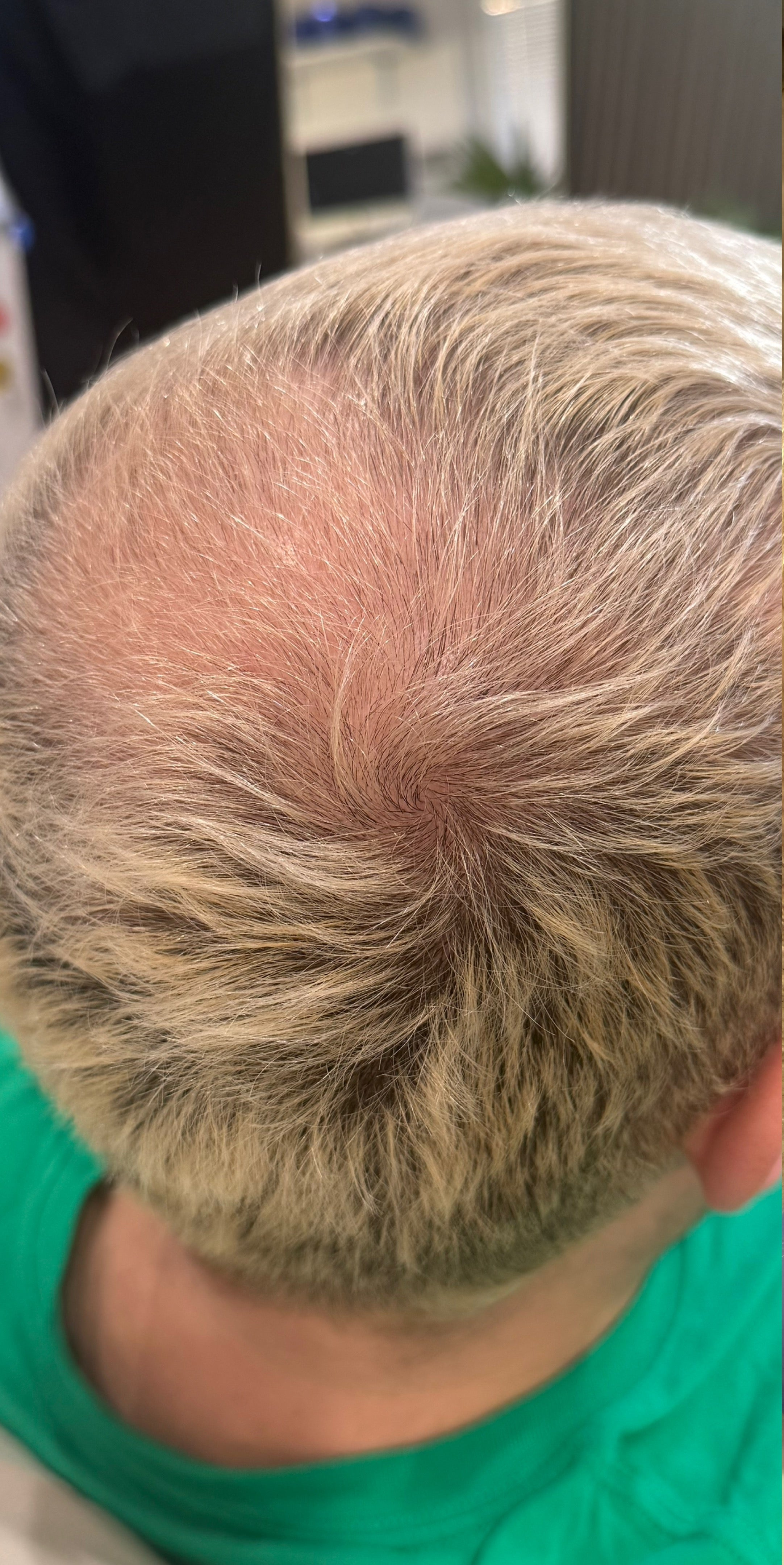 Close-up view from behind of a person's scalp showing thinning hair and a bald patch on the top, with light brown to gray hair around the sides and a green shirt visible at the bottom.