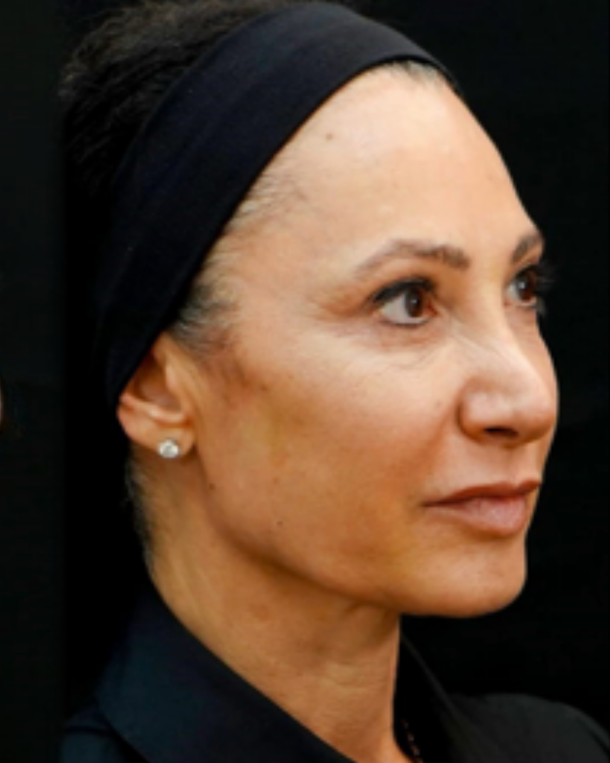 Image of woman's face, side view, after treatment showing improved signs of wrinkles.