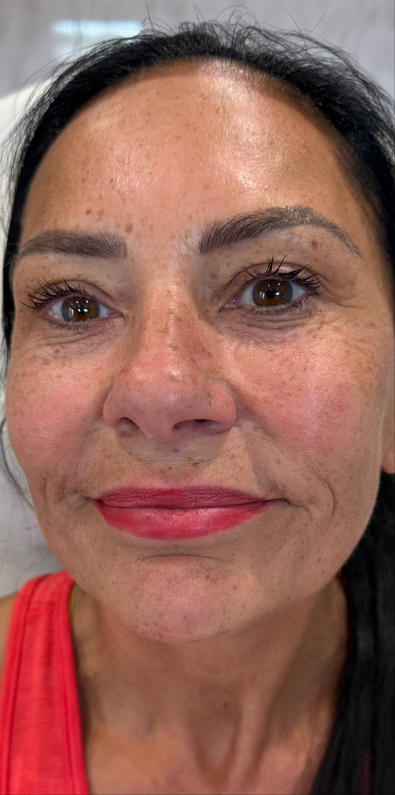 The image shows improved skin with firmness and less wrinkles after skin booster treatments.
