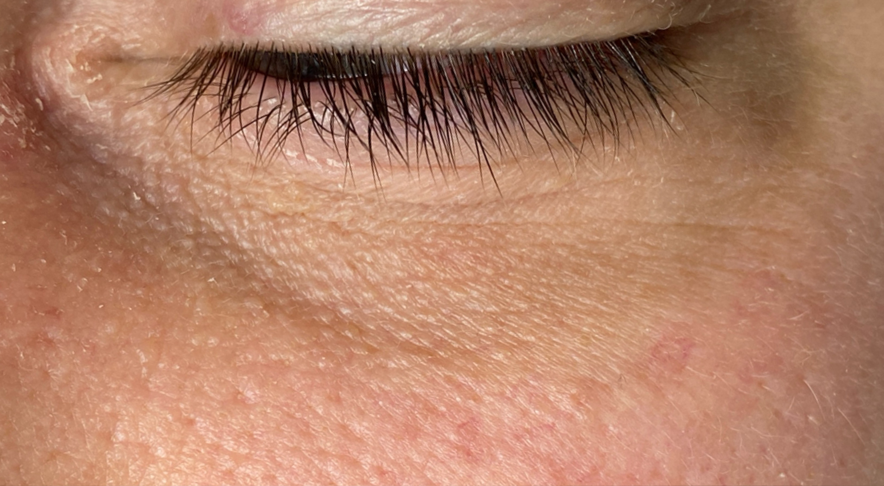 Close-up of a person's eye with visible skin texture and pores. Skin tag removed with cryotherapy treatment.