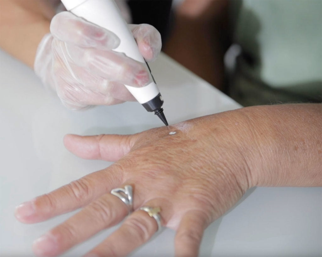 Person applying cryotherapy treatment to another person's hand with a gloved hand.