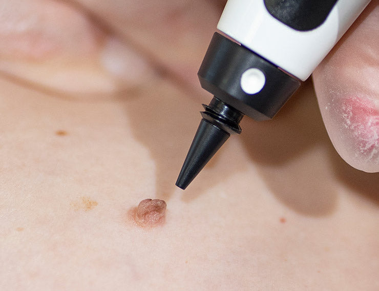 Cryotherapy treatment on the skin