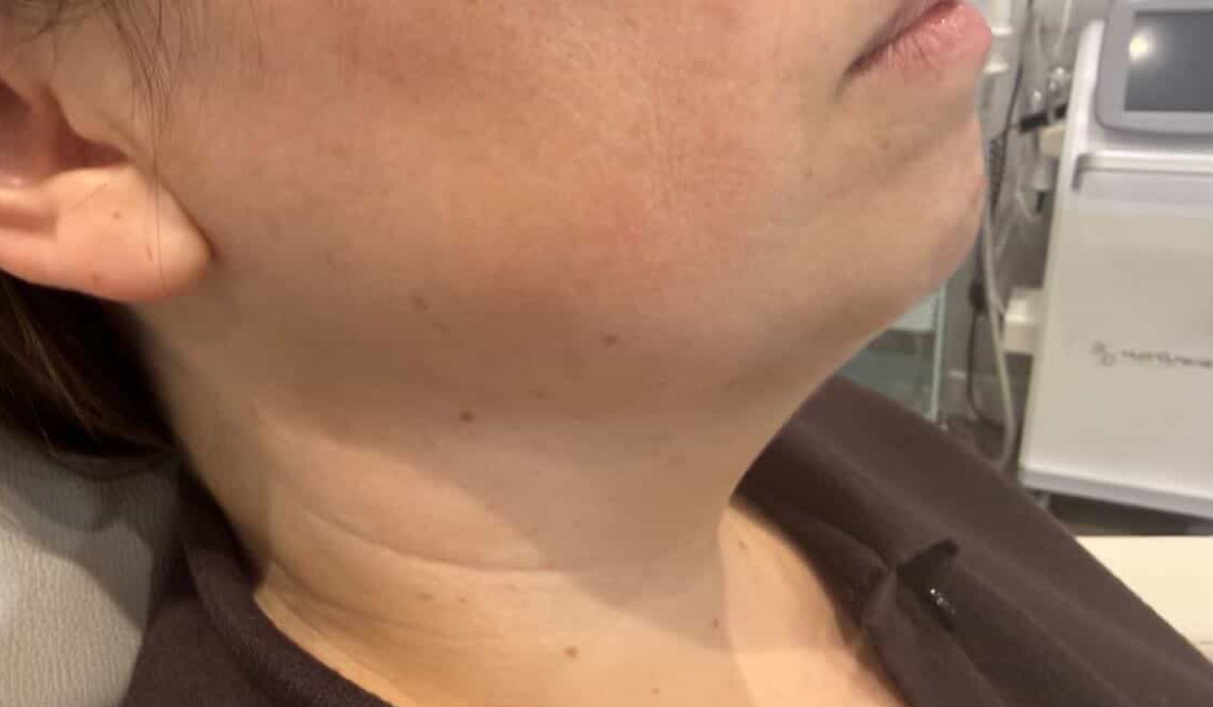 Close up of woman's cheek and neck area.