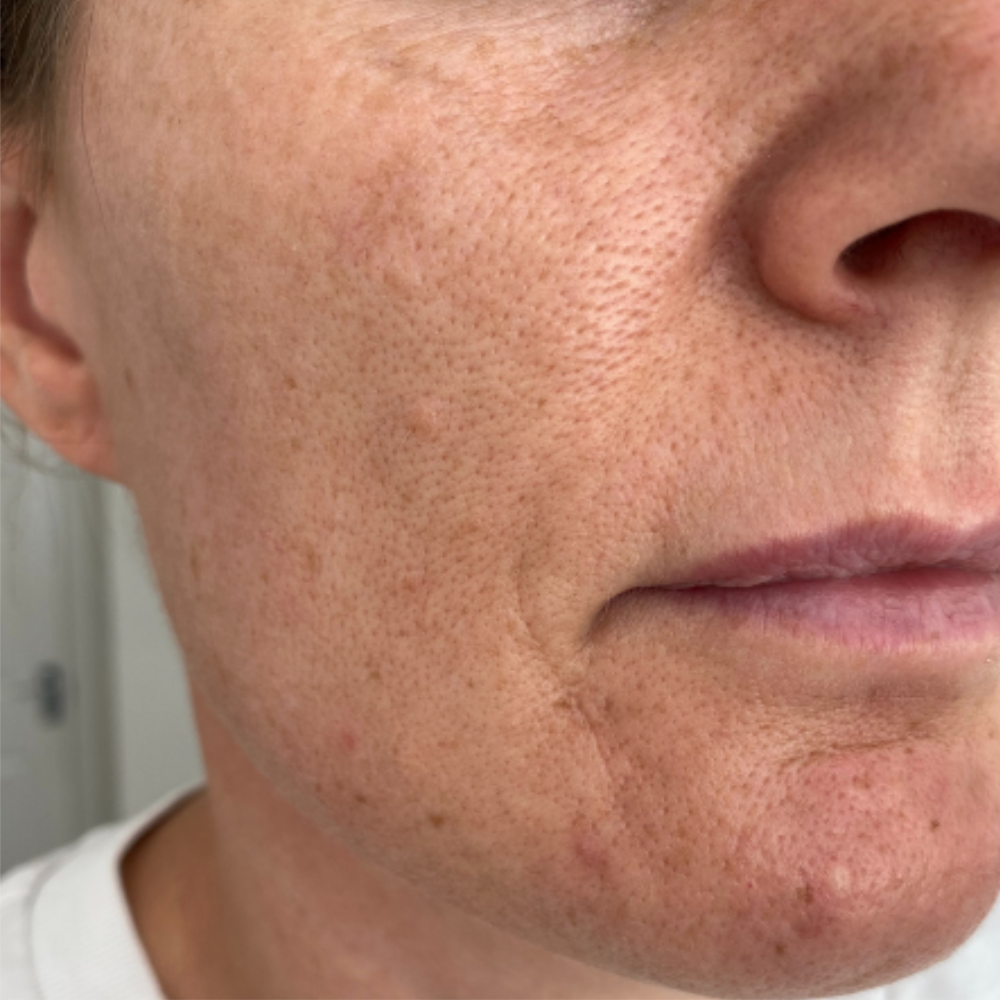 Close-up of a person's face with visible skin texture and pores.