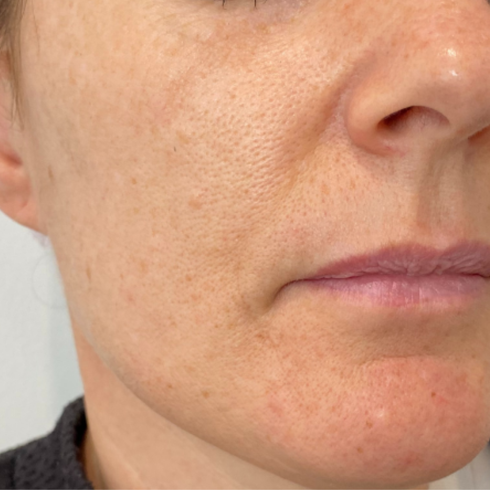 Close-up of a person's face with visible skin texture and pores.