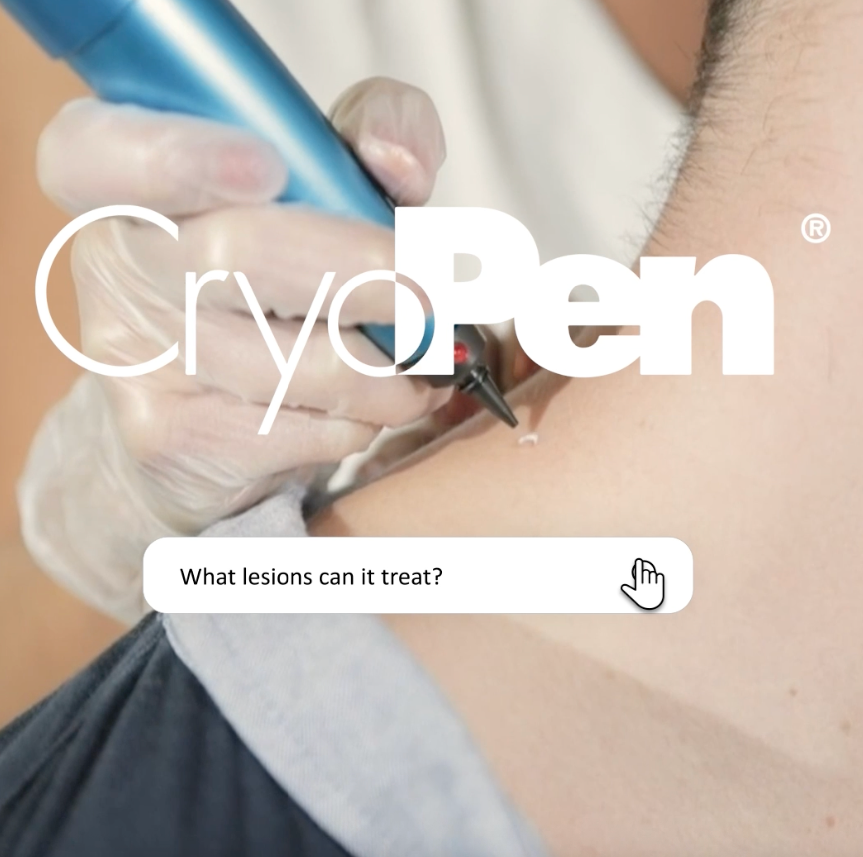 Cryptherapy