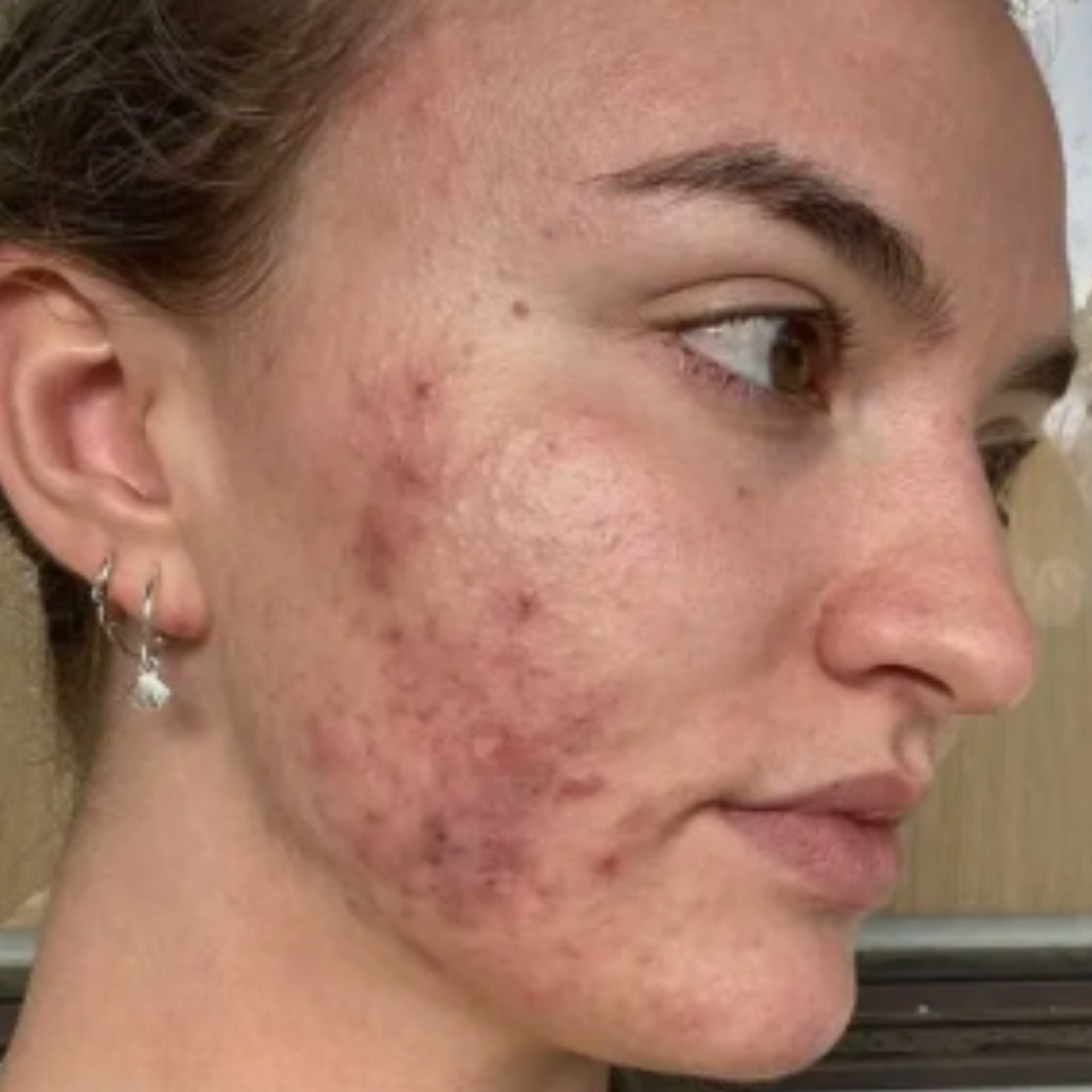 Close-up of a person's face with visible acne on the cheek.